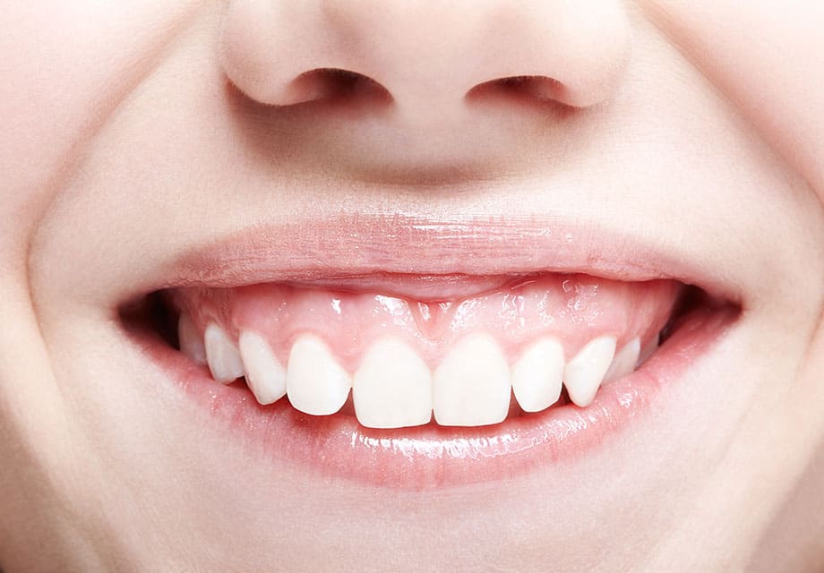 笑うと歯ぐきが出る「ガミースマイル」の治療
