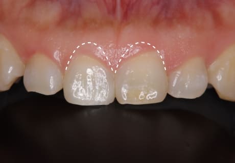 ガミースマイルを改善する審美的歯冠長延長術