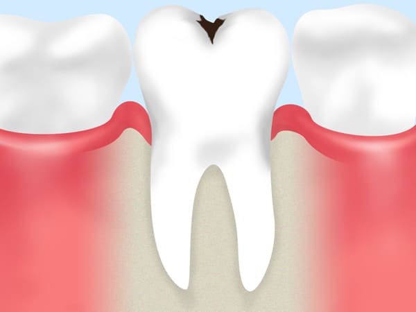 虫歯治療