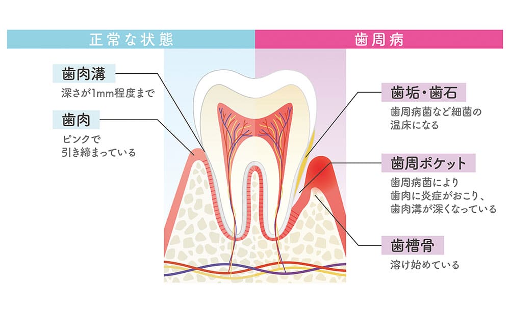 静かに進行し歯を失ってしまう歯周病