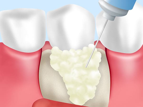 歯周組織再生療法