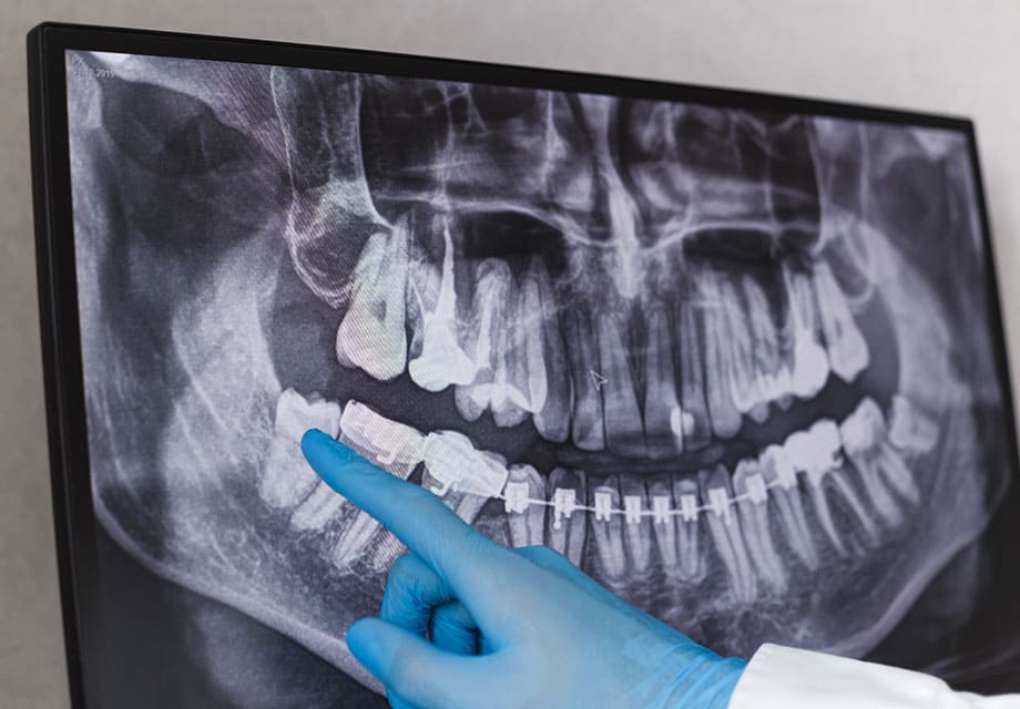 歯科用CTの精密分析で親知らずを安全に抜歯