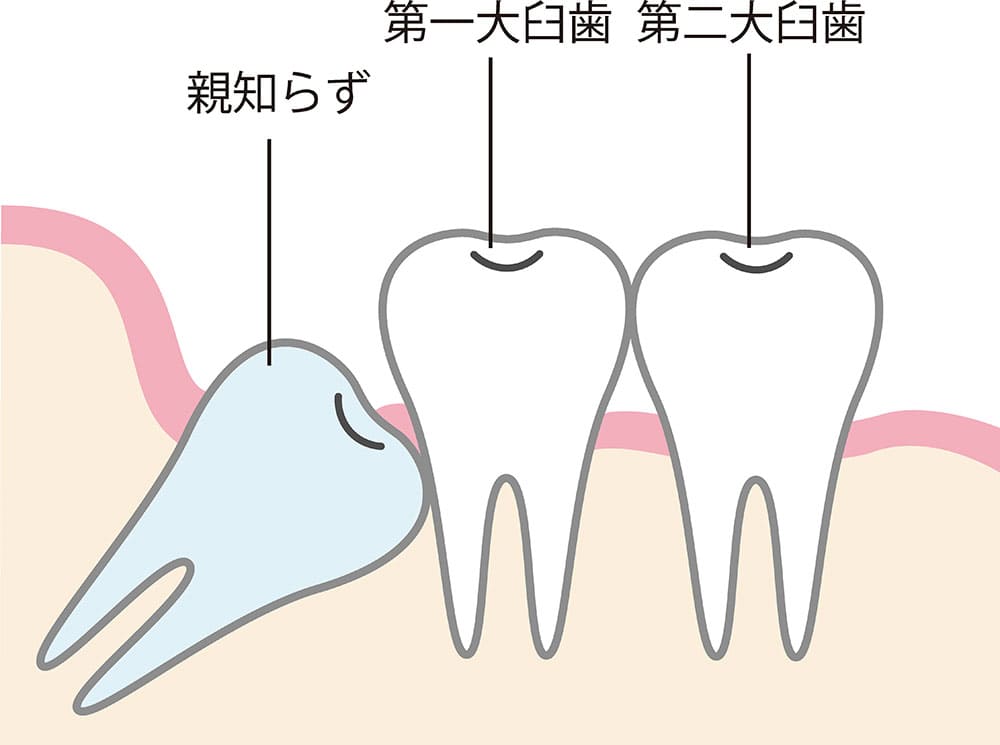 親知らずを抜歯すべきケース