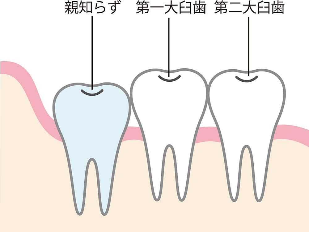 親知らずを抜歯しなくても良いケース